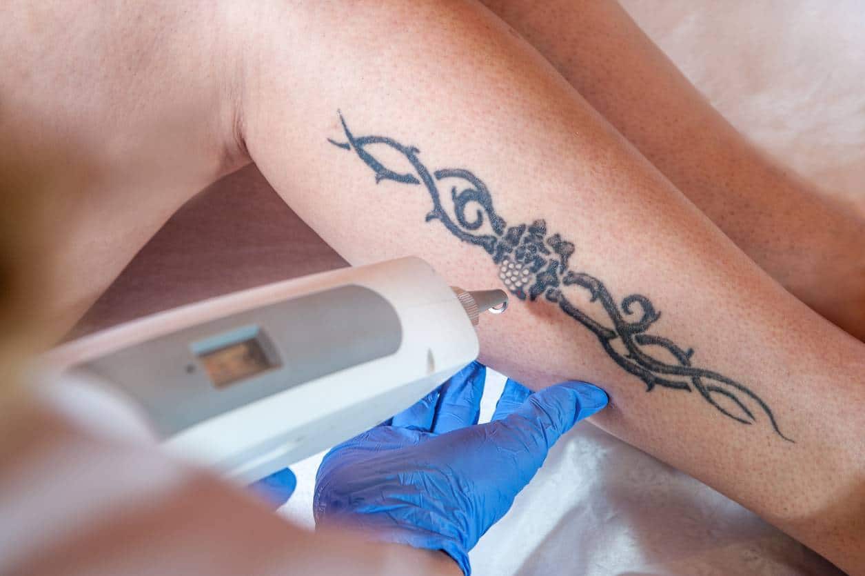 enlever un tatouage détatouage au laser détatouage Paris 